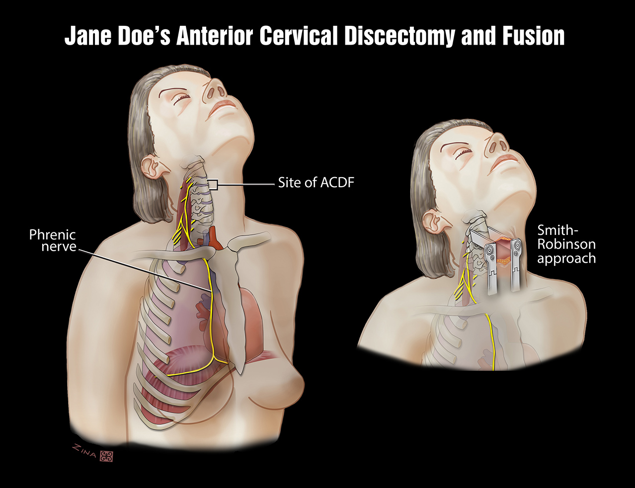 Anterior Cervical Discectomy and Fusion - Level Five Graphics